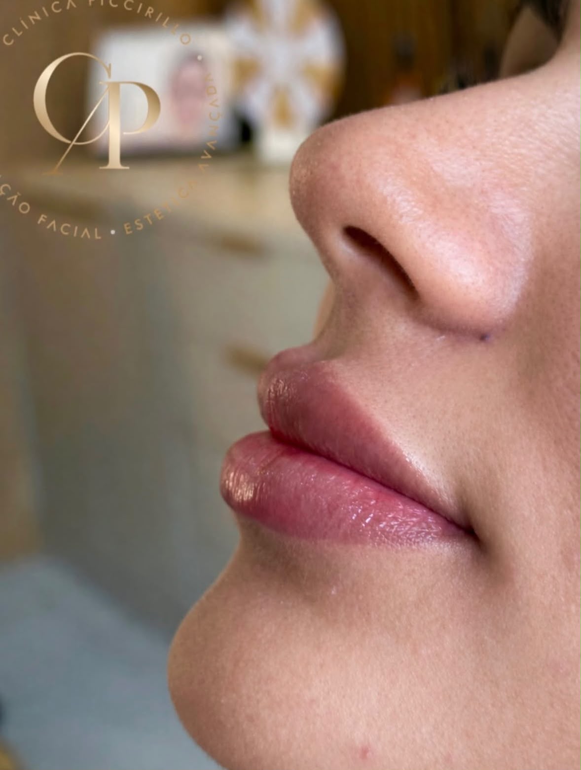 Resultado natural de preenchimento labial realizado na Clínica Piccirillo