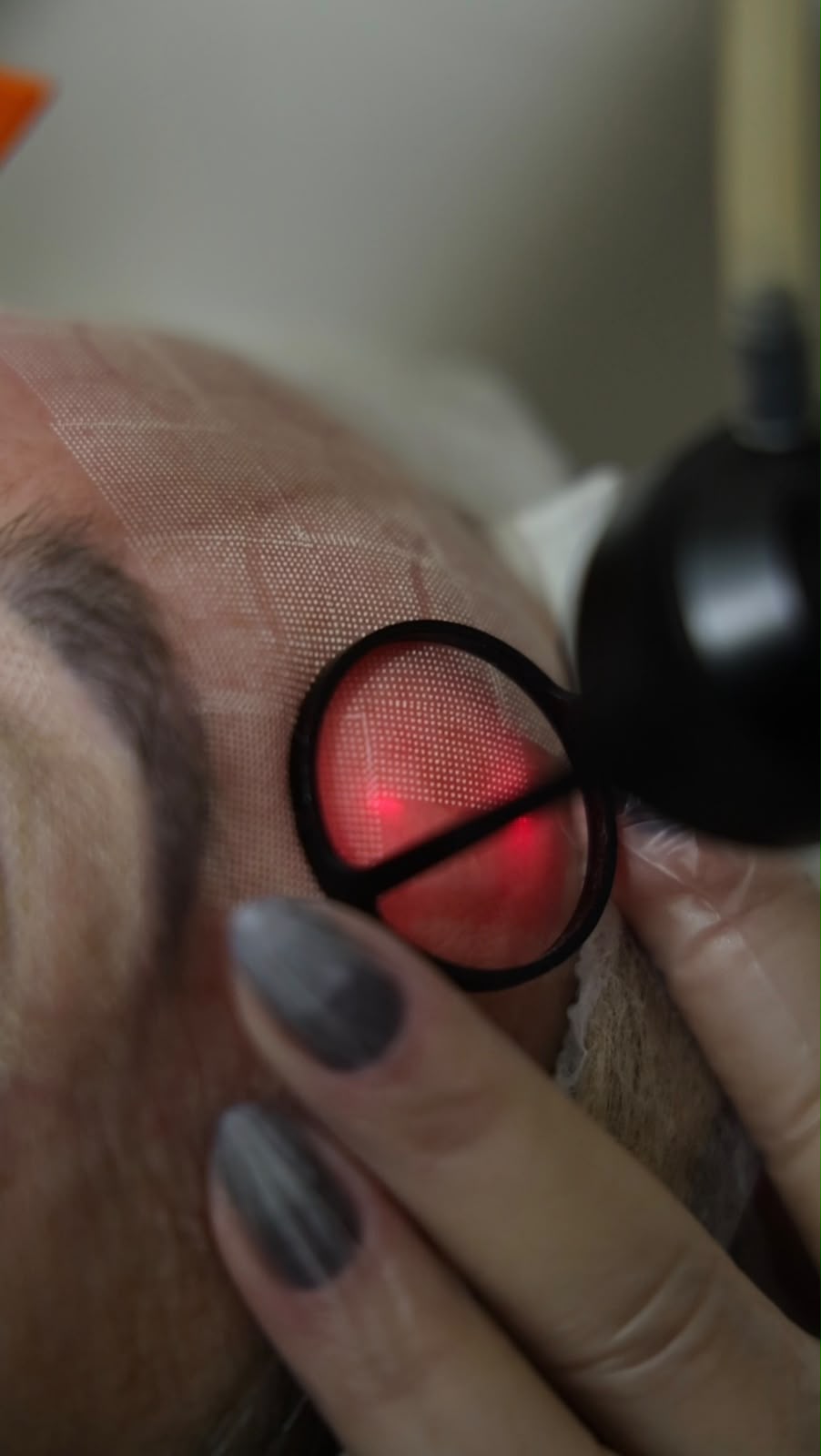 Tecnologia de laser aplicada em procedimento facial na Clínica Piccirillo